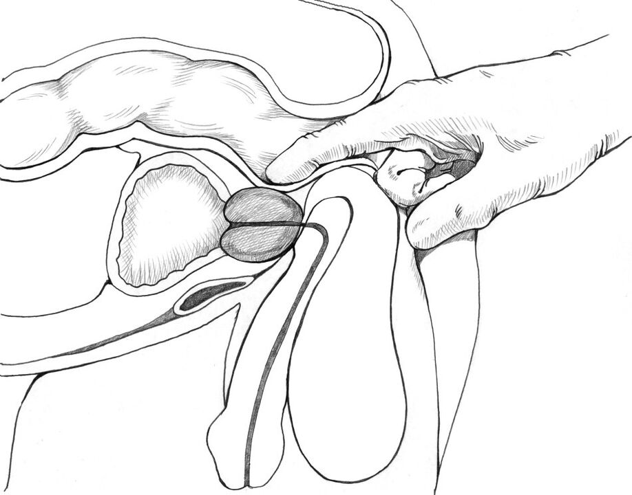 Le massage de la prostate appartient à l'ensemble des méthodes de traitement de la prostatite