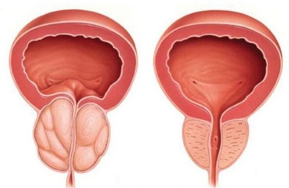 prostate normale et hypertrophiée avec prostatite